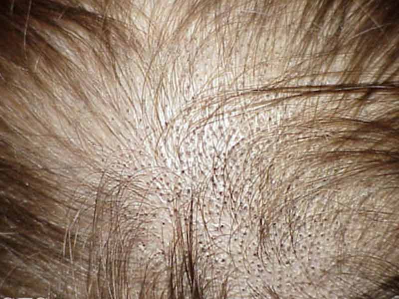 Signs of New Hair Growth -Fine and short hair growth