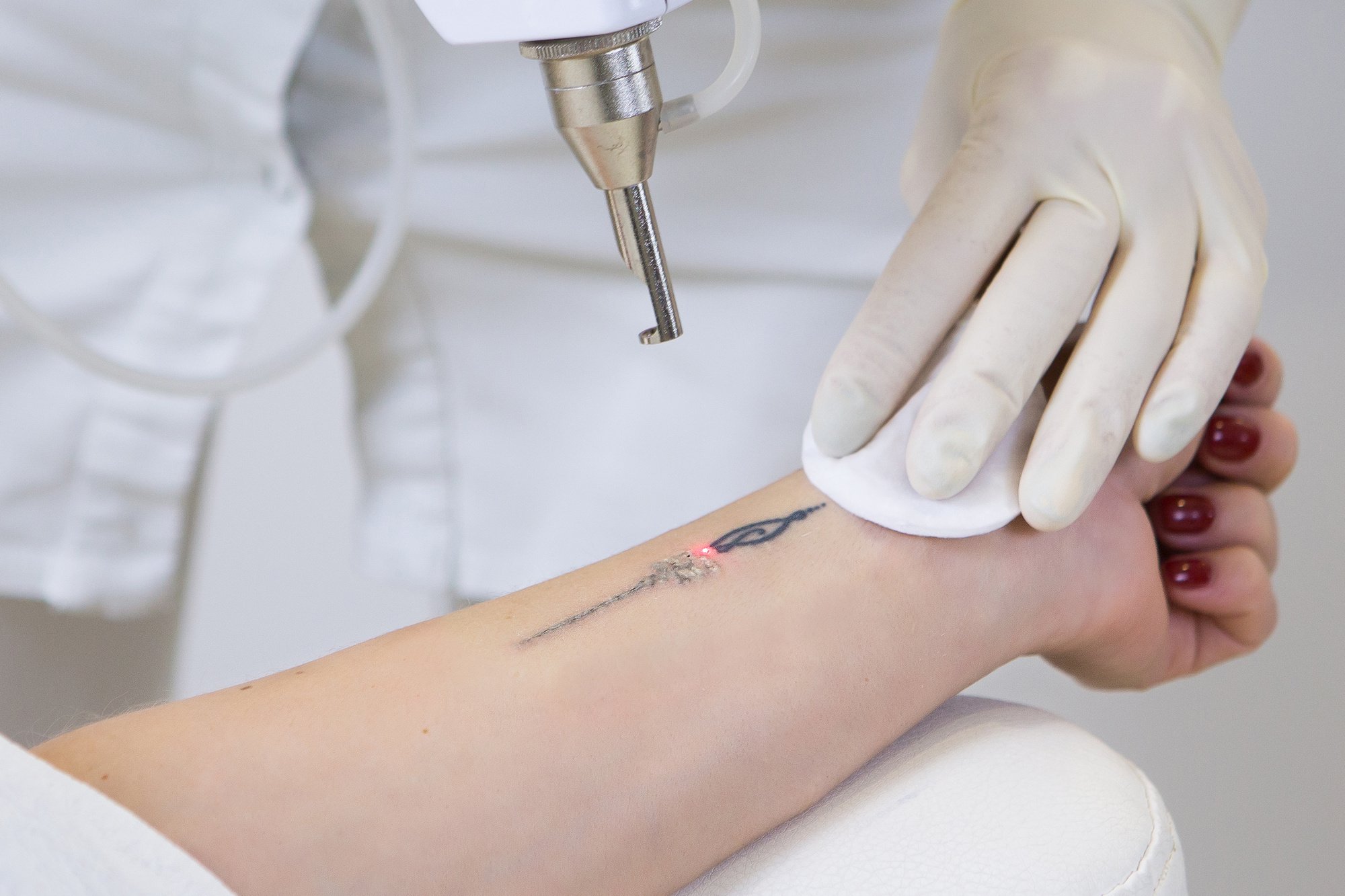 Tattoo Removal - Process, Aftercare and Costing - Get An Insight on How To Remove Tattoo 1 lazer